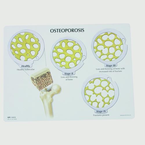 Комплект дисков по поражению костей при раке - 4 стадии остеопороза, 1019509, Модели отделов позвоночника и отдельных позвонков человека