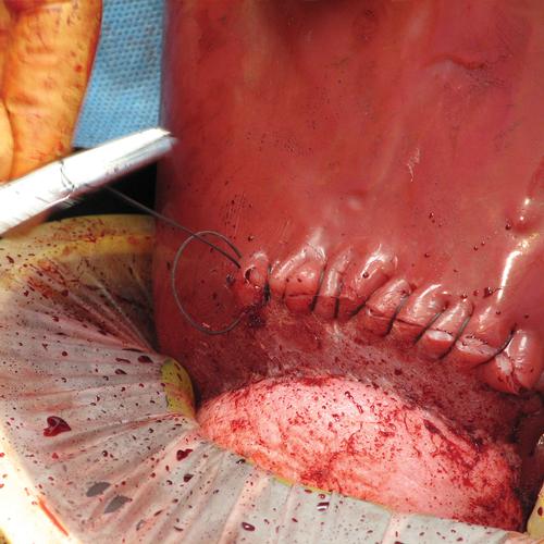 Simulador obstétrico para parto por cesariana completo - C-Celia, 1022567, Ginecologia