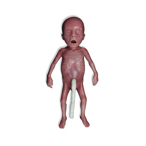 초미숙아 / 극저체중아(ELBW)  Micro-preemie Baby / Extremely Low Birth Weight Baby (ELBW)
, 1024668, Newborn