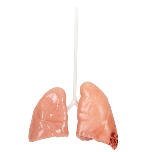 Lungs Damaged, 1025974, Cirugía