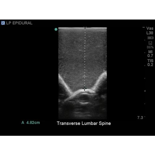 Blue Phantom Spinal Epidural, Lumbar Puncture and Cervical Epidural Training Model, 3012514, Ultrasound Skill Trainers
