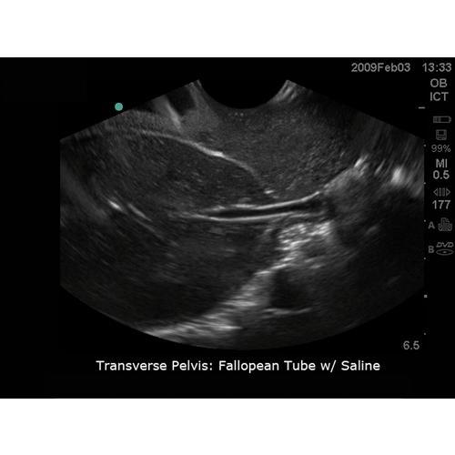 Blue Phantom Transvaginal SonoHysterography and Sonosalpingography Ultrasound Training Model, 3012522, Ultrasound Skill Trainers