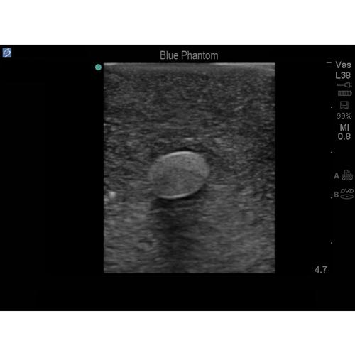 Blue Phantom Femoral Vessels and Nerve Replacement Tissue for BPP-025 to BPP-036, 3012555, Ultrasound Skill Trainers