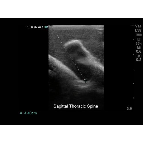Blue Phantom Thoracic Epidural Ultrasound Replacement Tissue, 3012595, Ultrasound Skill Trainers