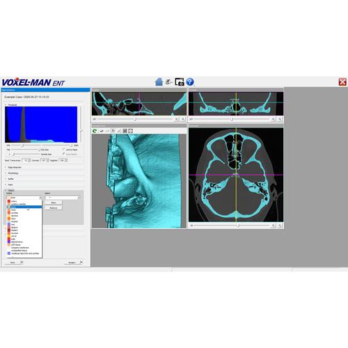 My Cases Software Module, 8001066, Exploración otorrinolaringológica