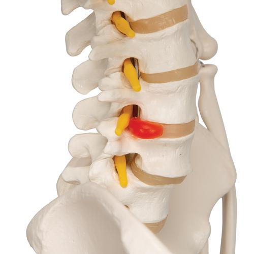 Menschliches Skelett Modell "Fred", lebensgroß mit flexibler einstellbarer Wirbelsäule mit Nerven, Arterien & Bandscheibenvorfall, auf Metallstativ mit Rollen, 1020178 [A15], Skelette lebensgroß