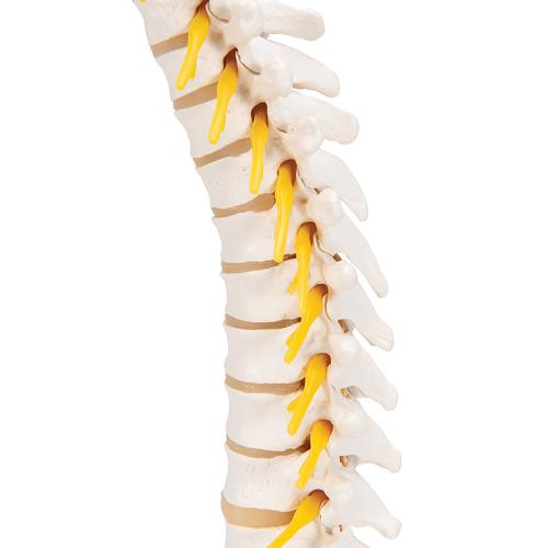 Lumbar Spinal Column with Dorso-lateral Prolapsed Intervertebral Disc –