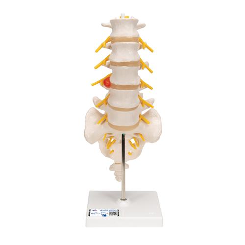 Columnavertebral lumbar con hernia discal dorsolateral, 1000150 [A76/5], Modelos de vértebras