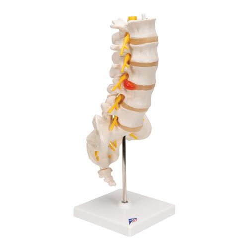 Human Lumbar Spinal Column Model with Dorso-Lateral Prolapsed Intervertebral Disc, 1000150 [A76/5], Vertebra Models