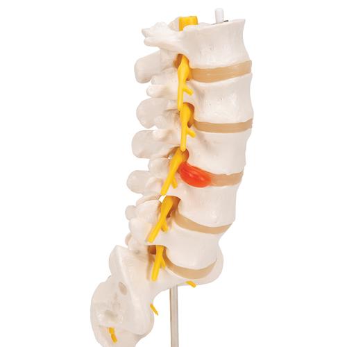 Human Lumbar Spinal Column Model with Dorso-Lateral Prolapsed Intervertebral Disc, 1000150 [A76/5], Vertebra Models