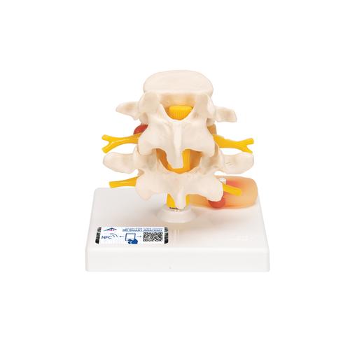 Human Lumbar Spinal Column with Prolapsed Intervertebral Disc, 1000149 [A76], Vertebra Models