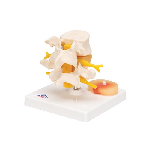 추간판 탈출증이 있는 요추 모형 Lumbar Spinal Column with Prolapsed Intervertebral Disc, 1000149 [A76], 척추뼈 모형