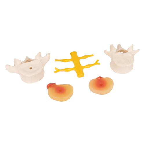 추간판 탈출증이 있는 요추 모형 Lumbar Spinal Column with Prolapsed Intervertebral Disc, 1000149 [A76], 척추뼈 모형