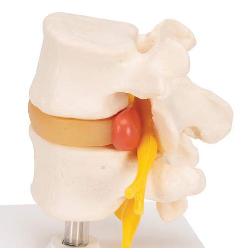 Human Lumbar Spinal Column with Prolapsed Intervertebral Disc, 1000149 [A76], Vertebra Models