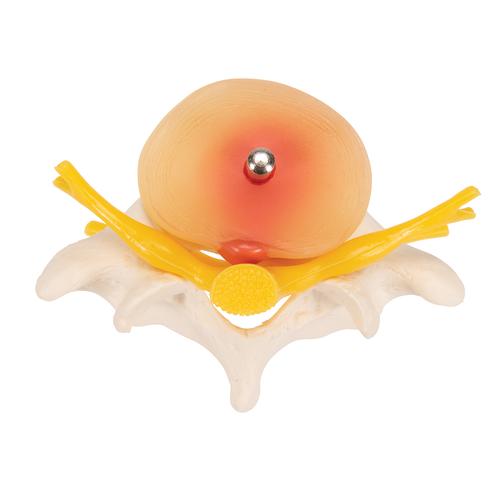 Human Lumbar Spinal Column with Prolapsed Intervertebral Disc, 1000149 [A76], Vertebra Models