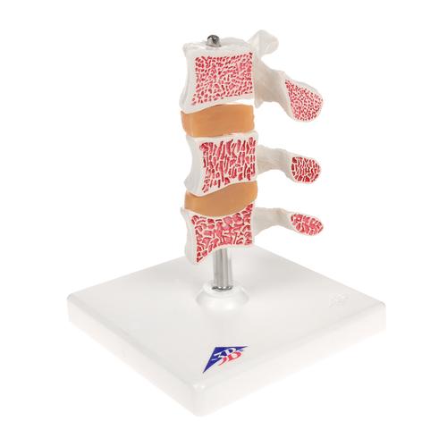 Deluxe Human Osteoporosis Model (3 Vertebrae with Discs ), Removable on Stand, 1000153 [A78], Vertebra Models