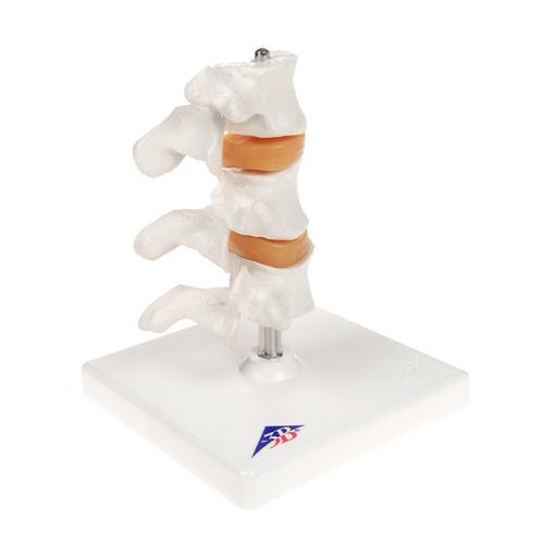 Deluxe Human Osteoporosis Model (3 Vertebrae with Discs ), Removable on Stand, 1000153 [A78], Vertebra Models