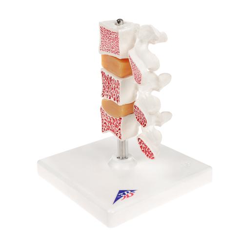 Deluxe Human Osteoporosis Model (3 Vertebrae with Discs ), Removable on Stand, 1000153 [A78], Arthritis and Osteoporosis Education