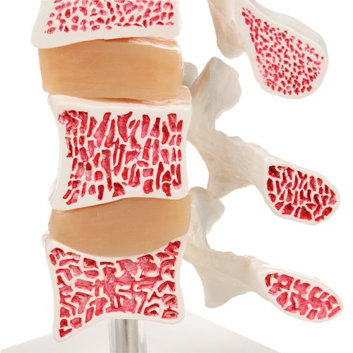 Deluxe Human Osteoporosis Model (3 Vertebrae with Discs ), Removable on Stand, 1000153 [A78], Arthritis and Osteoporosis Education