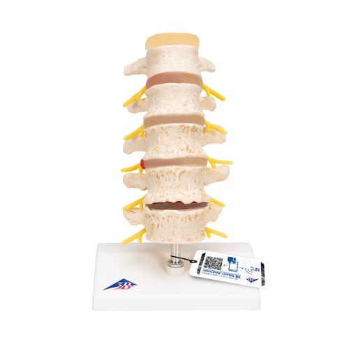 퇴행성 요추와 추간판탈출증 모형 Stages of disc prolapse and vertebral degeneration, 1000158 [A795], 척추뼈 모형