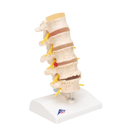 퇴행성 요추와 추간판탈출증 모형 Stages of disc prolapse and vertebral degeneration, 1000158 [A795], 척추뼈 모형