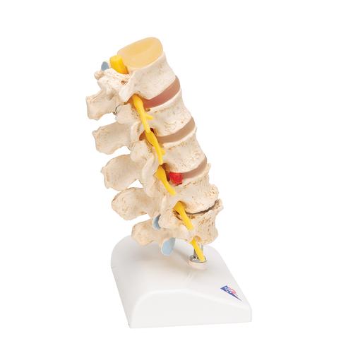 Estadios del prolapso del cartílago interventeral y de la degeneración vertebral, 1000158 [A795], Modelos de vértebras