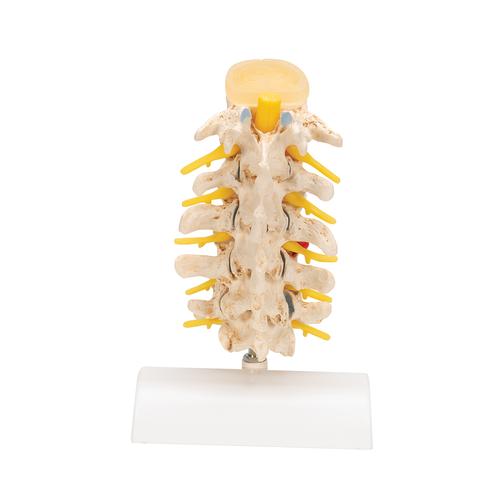 Stages of Disc Prolapse and Vertebral Degeneration, 1000158 [A795], Vertebra Models