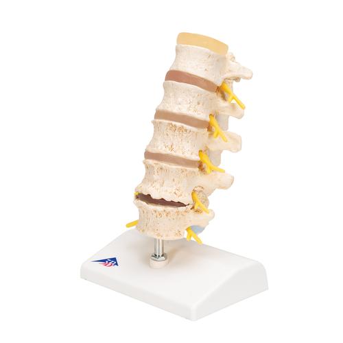 퇴행성 요추와 추간판탈출증 모형 Stages of disc prolapse and vertebral degeneration, 1000158 [A795], 척추뼈 모형