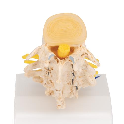 Stages of Disc Prolapse and Vertebral Degeneration, 1000158 [A795], Vertebra Models