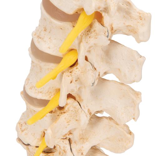 퇴행성 요추와 추간판탈출증 모형 Stages of disc prolapse and vertebral degeneration, 1000158 [A795], 척추뼈 모형