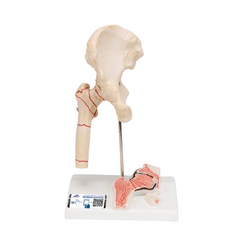 Human Femoral Fracture & Hip Osteoarthritis Model, 1000175 [A88], Arthritis and Osteoporosis Education