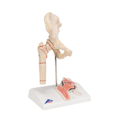 Human Femoral Fracture & Hip Osteoarthritis Model, 1000175 [A88], Arthritis and Osteoporosis Education