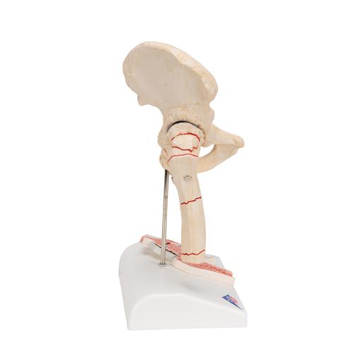 Human Femoral Fracture & Hip Osteoarthritis Model, 1000175 [A88], Arthritis and Osteoporosis Education