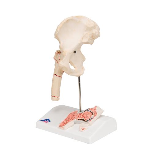 Hüftgelenkmodell mit Oberschenkelbruch & Hüftgelenkverschleiß, 1000175 [A88], Arthritis und Osteoporose