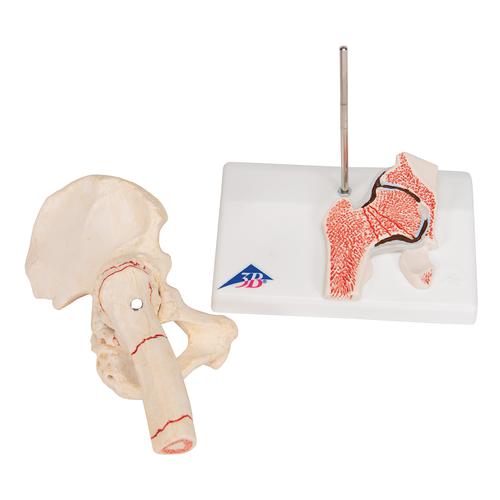 Human Femoral Fracture & Hip Osteoarthritis Model, 1000175 [A88], Arthritis and Osteoporosis Education