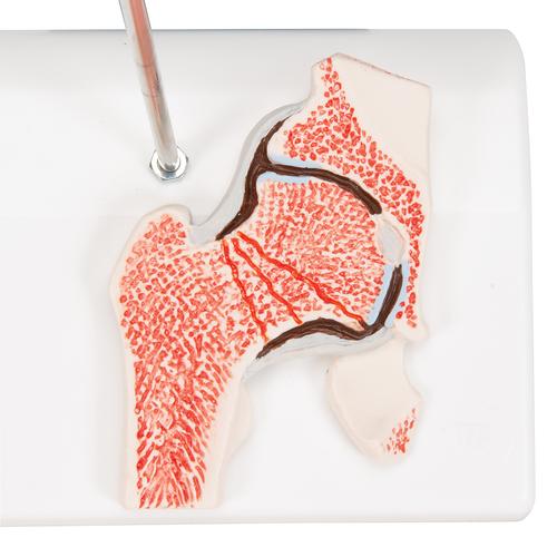 Human Femoral Fracture & Hip Osteoarthritis Model, 1000175 [A88], Arthritis and Osteoporosis Education