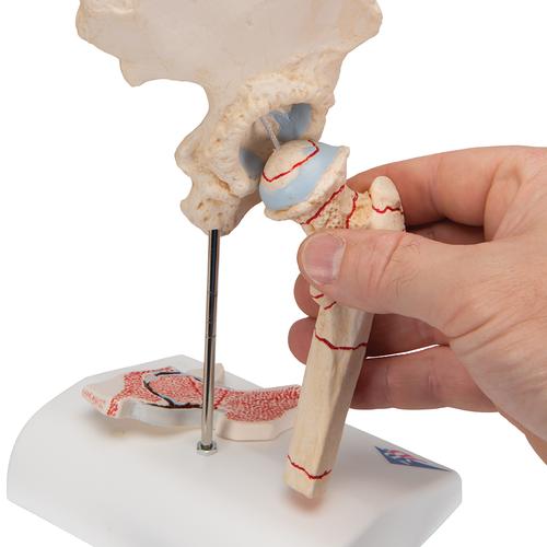 Fractura de fémur y desgaste de la articulación de la cadera, 1000175 [A88], Educación sobre artritis y osteoporosis