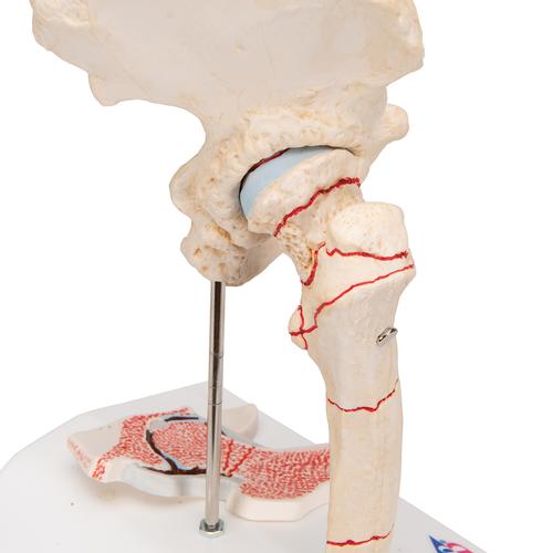 Human Femoral Fracture & Hip Osteoarthritis Model, 1000175 [A88], Arthritis and Osteoporosis Education