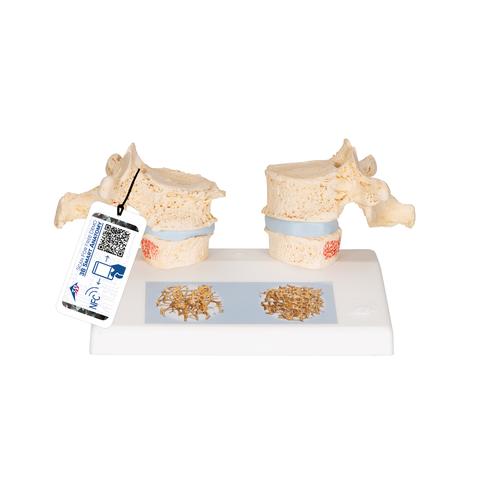 골다공증 모형 Osteoporosis Model, 1000182 [A95], 인체 척추 모형