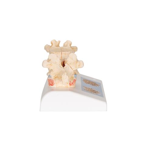 Modelo de osteoporosis, 1000182 [A95], Modelos de Columna vertebral