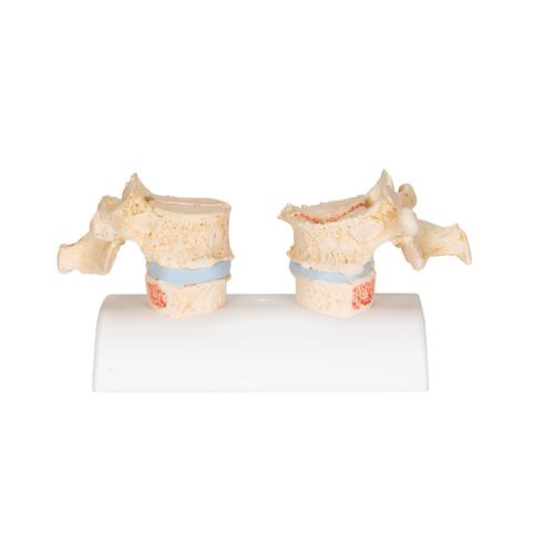 Osteoporose Modell des 11. und 12. Brustwirbels, 1000182 [A95], Arthritis und Osteoporose