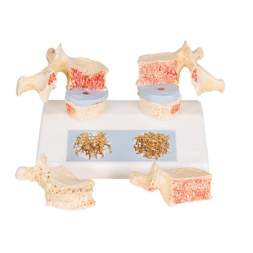 Osteoporosis Didactic Model, 1000182 [A95], Vertebra Models