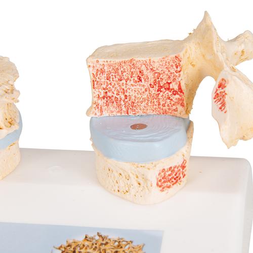 Osteoporosis Didactic Model, 1000182 [A95], Arthritis and Osteoporosis Education