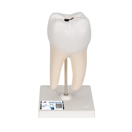 하악 대구치 충치 모형, 2파트 Lower Twin-Root Molar showing cavities, 2 part, 1000243 [D10/4], 치아 모형