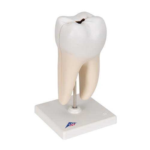 하악 대구치 충치 모형, 2파트 Lower Twin-Root Molar showing cavities, 2 part, 1000243 [D10/4], 치아 모형