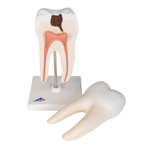 Zahn Modell Unterer Zweiwurzeliger Molar mit Karies, 2-teilig, 1000243 [D10/4], Zahnmodelle