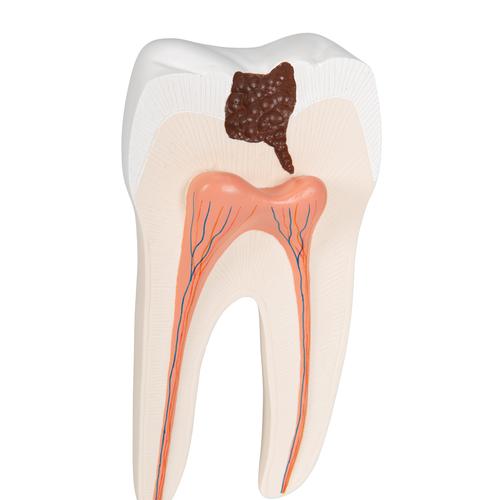 Dente molare inferiore a due radici, con carie, in 2 parti, 1000243 [D10/4], Modelli Dentali