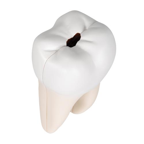 Zahn Modell Unterer Zweiwurzeliger Molar mit Karies, 2-teilig, 1000243 [D10/4], Zahnmodelle