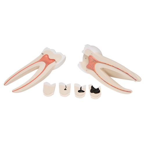 Giant Molar with Dental Cavities Human Tooth Model, 15 times Life-Size, 6 part, 1013215 [D15], Dental Models