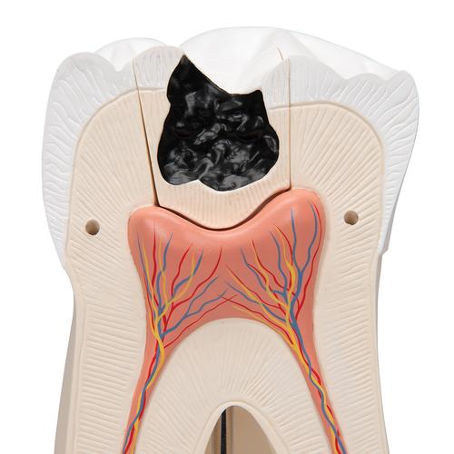 Giant Molar with Dental Cavities Human Tooth Model, 15 times Life-Size, 6 part, 1013215 [D15], Dental Models